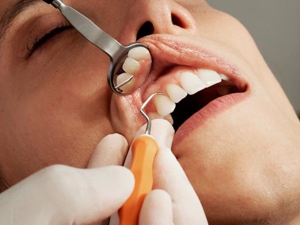 Quelle est la meilleure technique pour blanchir les dents naturellement sans endommager l'émail?